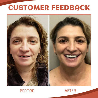 Silicone Denture Set ~ Achieve a natural, confident smile instantly*