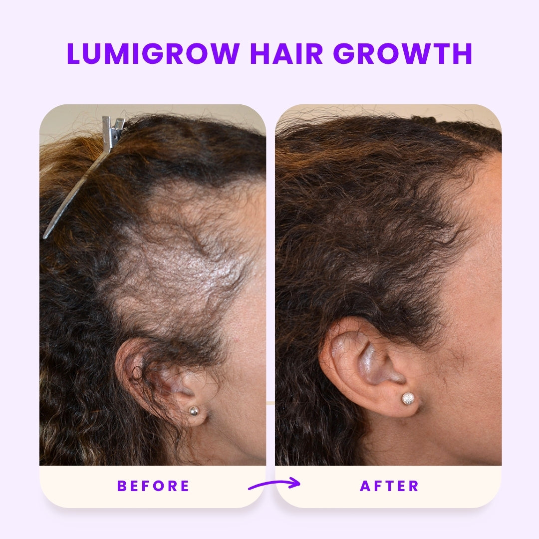 Lumigrow Hair Growth Gummies ~ Clinically proven formula for real results-